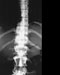 Lumbar Myelogram AP