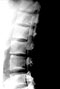 Lumbar Myelogram Lateral