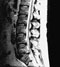 Lumbar Spine Zoom